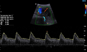 Ecografía Doppler