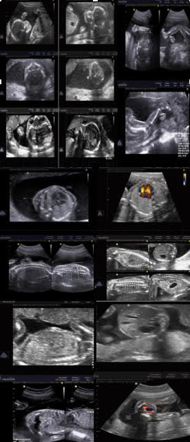 Scan fetal